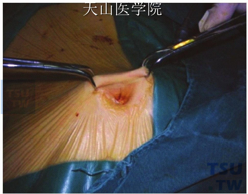 肚脐穿刺多长时间会好