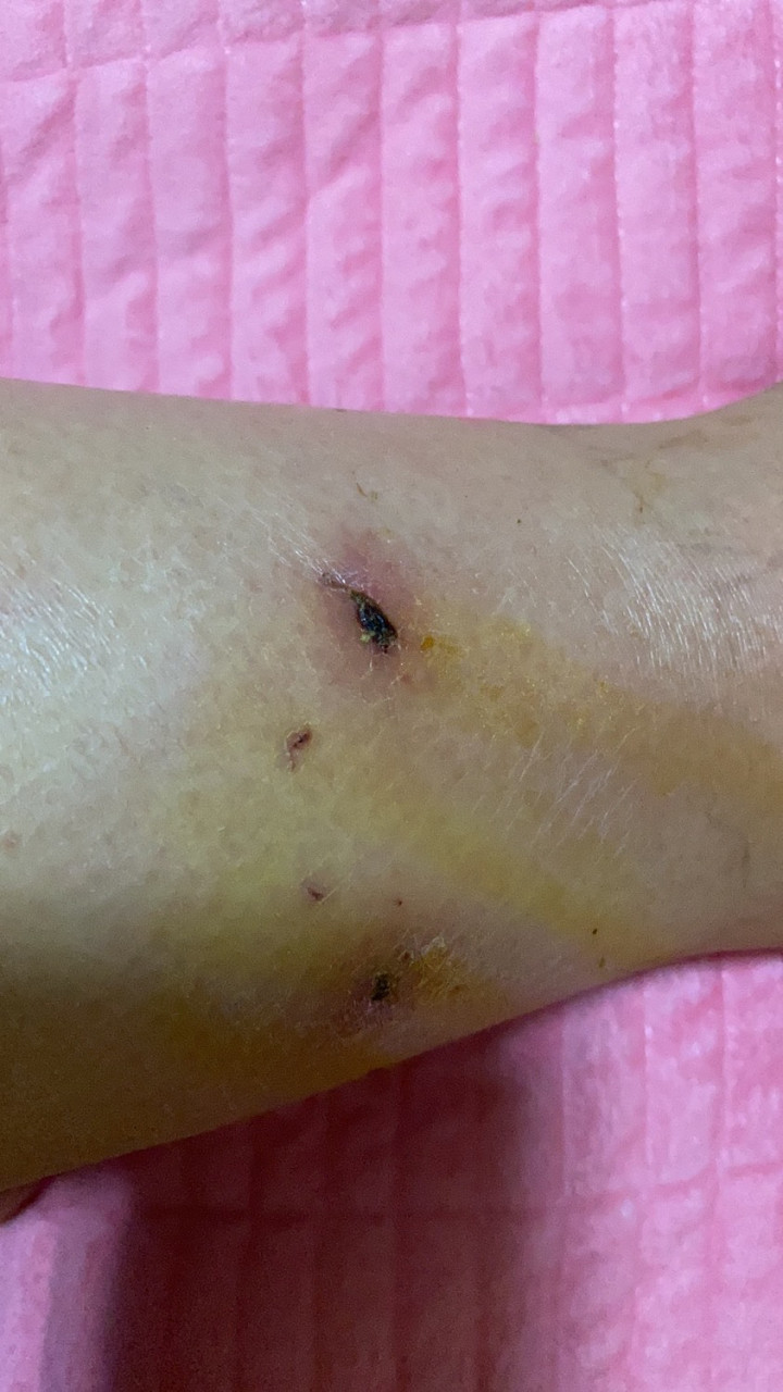人被猫虱子咬了是什么样子的