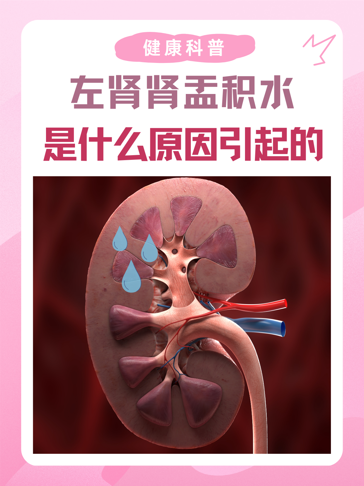 肾积水有哪些症状表现